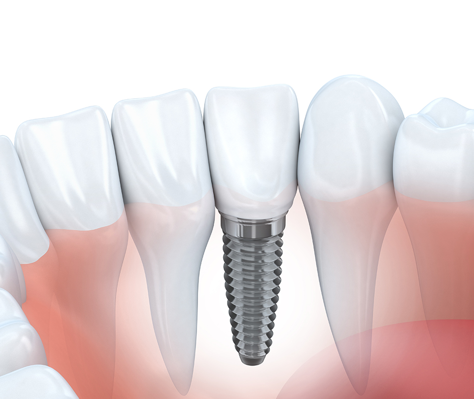 Ein Modell, wie ein gesetztes Implantat aussieht.